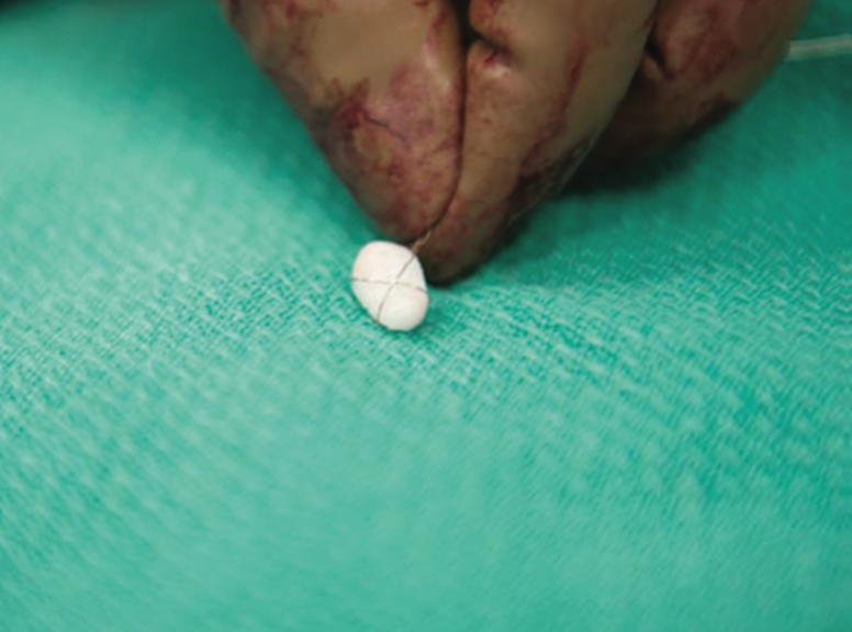 FDM printed patella pictured before implantation.