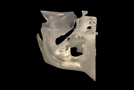 Patient-specific 3D printed models enable preparation of hybrid titanium mesh implants prior to surgery, reducing operating time.