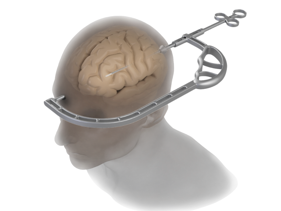 Multiple iterations of the Caroline Guide were printed on the F370
FDM printer for ergonomic and functional evaluations before the  final model was fabricated in metal.