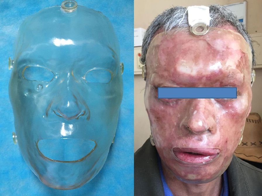 A 3D printed mask (left) and shown fitted on the patient (right).1 