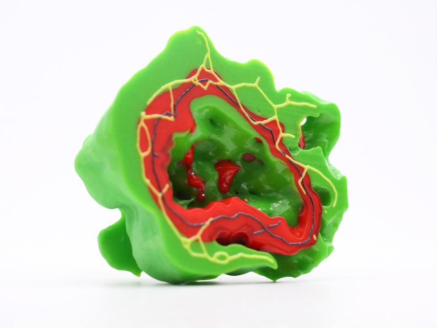 Stratasys Tumor