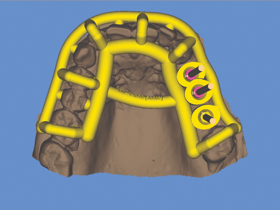 A 3D CAD model of surgical guide used to position implants on the patient’s jaw bone.