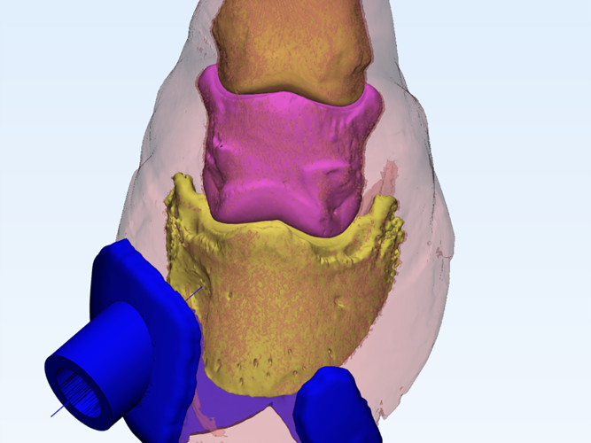 keratoma fix CAD model