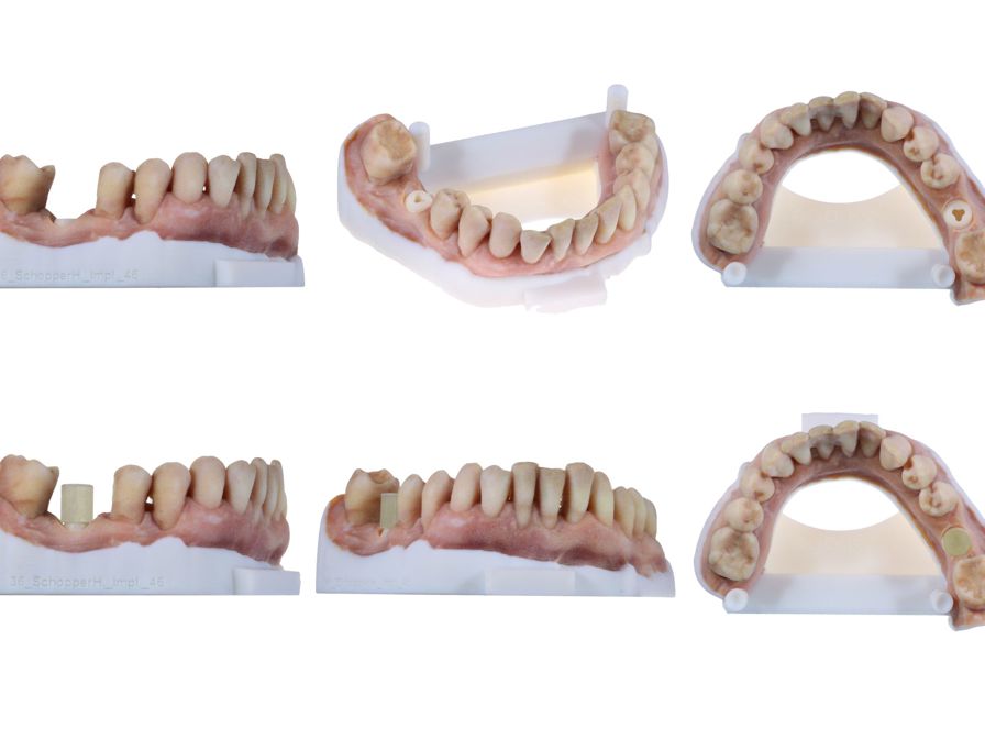Stratasys Patent Implantatmodell