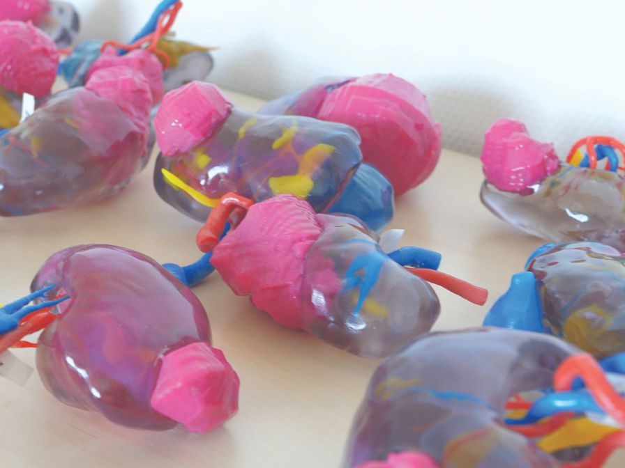Unique color, multi-material 3D printing enables CHU to 3D
print ultra-realistic models of patients’ kidneys, providing clear
visualization of tumors (pink area) pre-surgery.