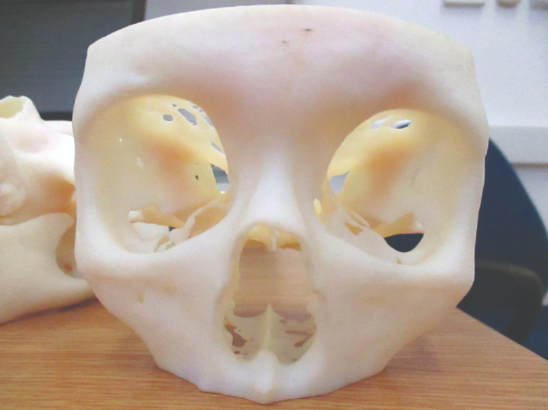 3D printed model of a patient’s facial bone structure.