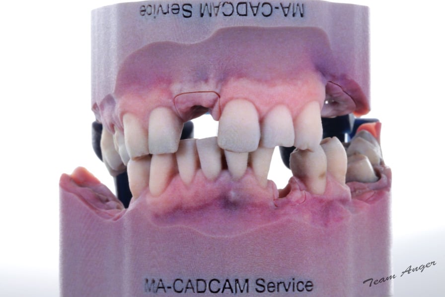 dental model printed with j5 dentajet