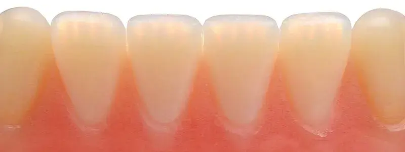 truedent-lower-incisal