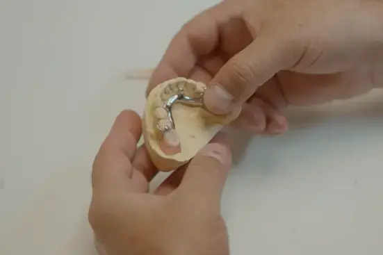Stratasys TrueDent 3D Printed partial denture with metal framework